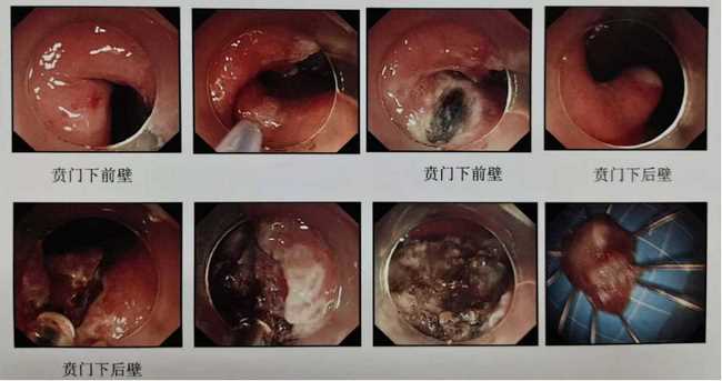 炎夏漸至，“胃腸”已碌 ——狹小的空間見證消化內(nèi)鏡微創(chuàng)手術(shù)的魅力(圖2)