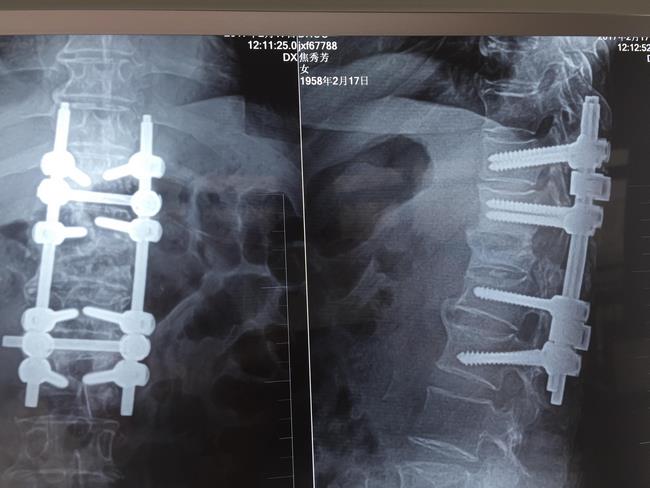 我院骨四科成功開展一例脊柱陳舊性骨折角狀后凸矯形手術(shù)(圖3)