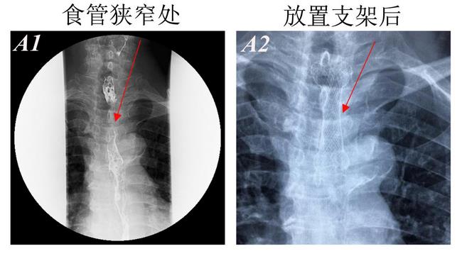 消化科運(yùn)用多學(xué)科會(huì)診（MDT）微創(chuàng)診治食管惡性腫瘤侵潤(rùn)所致食、氣道梗阻(圖4)