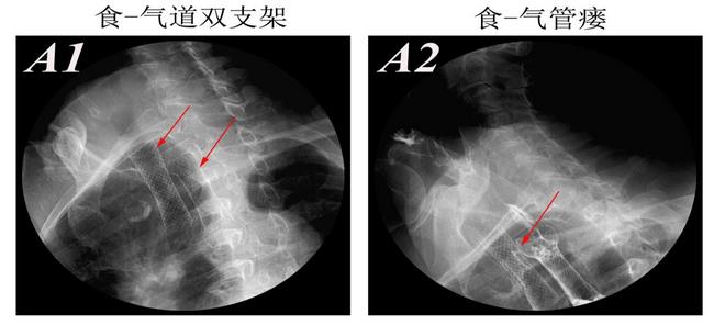消化科運(yùn)用多學(xué)科會(huì)診（MDT）微創(chuàng)診治食管惡性腫瘤侵潤(rùn)所致食、氣道梗阻(圖8)
