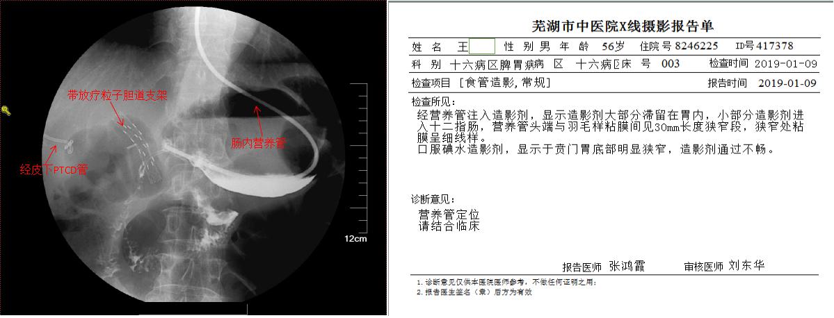 三個支架植入后——我院脾胃病1科成功為腫瘤患者施行內(nèi)鏡下高難度多支架植入術(shù)(圖2)