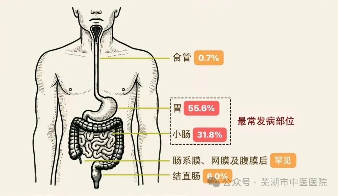 狡猾的“隱形殺手”——胃腸間質(zhì)瘤（GIST）(圖1)
