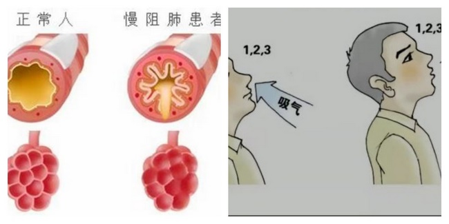 慢肺 (Copy).jpg
